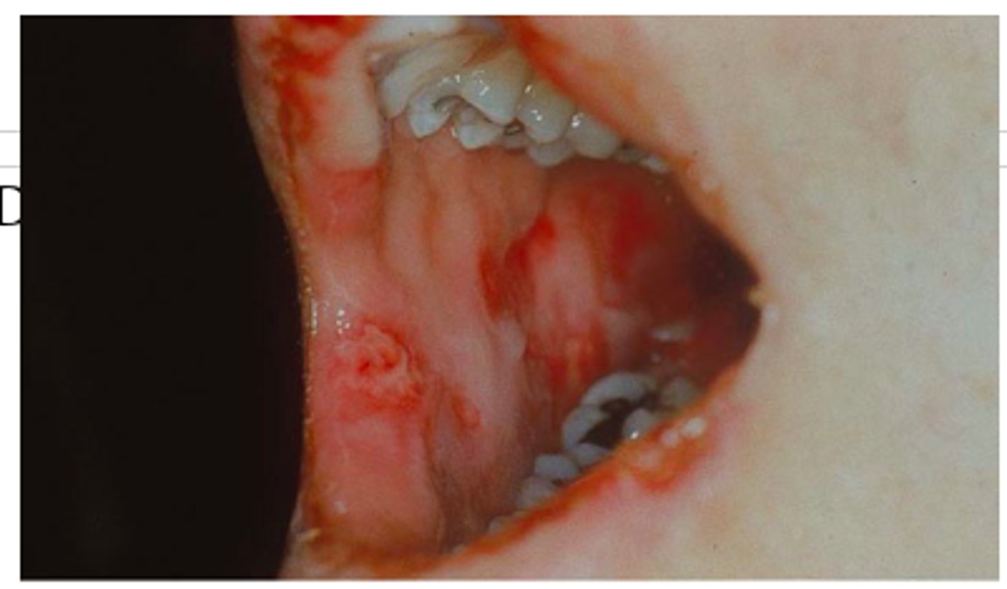 <p>• Pruritus</p><p>• Pain (esp mouth lesions)</p><p>• Constitutional</p>