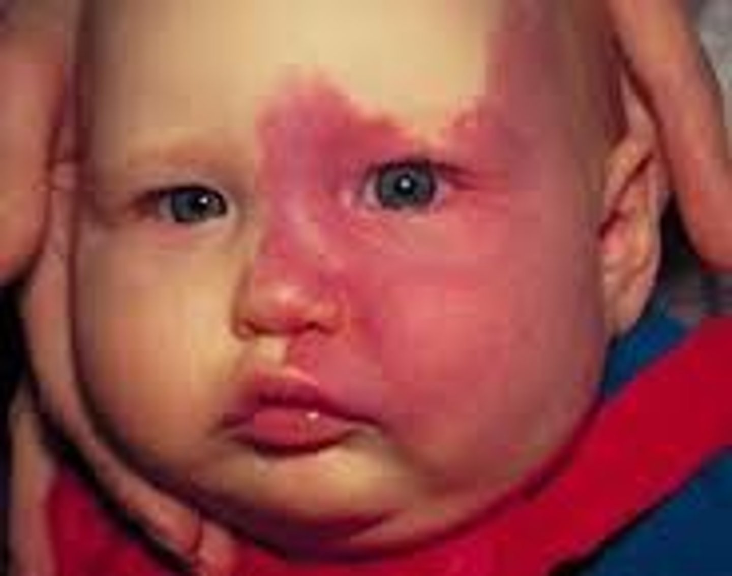 <p>birthmark</p>
