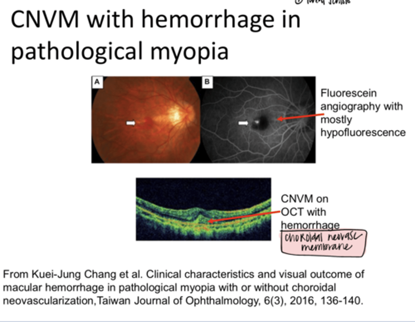<p>Choroidal Neovascular Membrane with Hemorrhage in Pathological Myopia (Pic)</p>