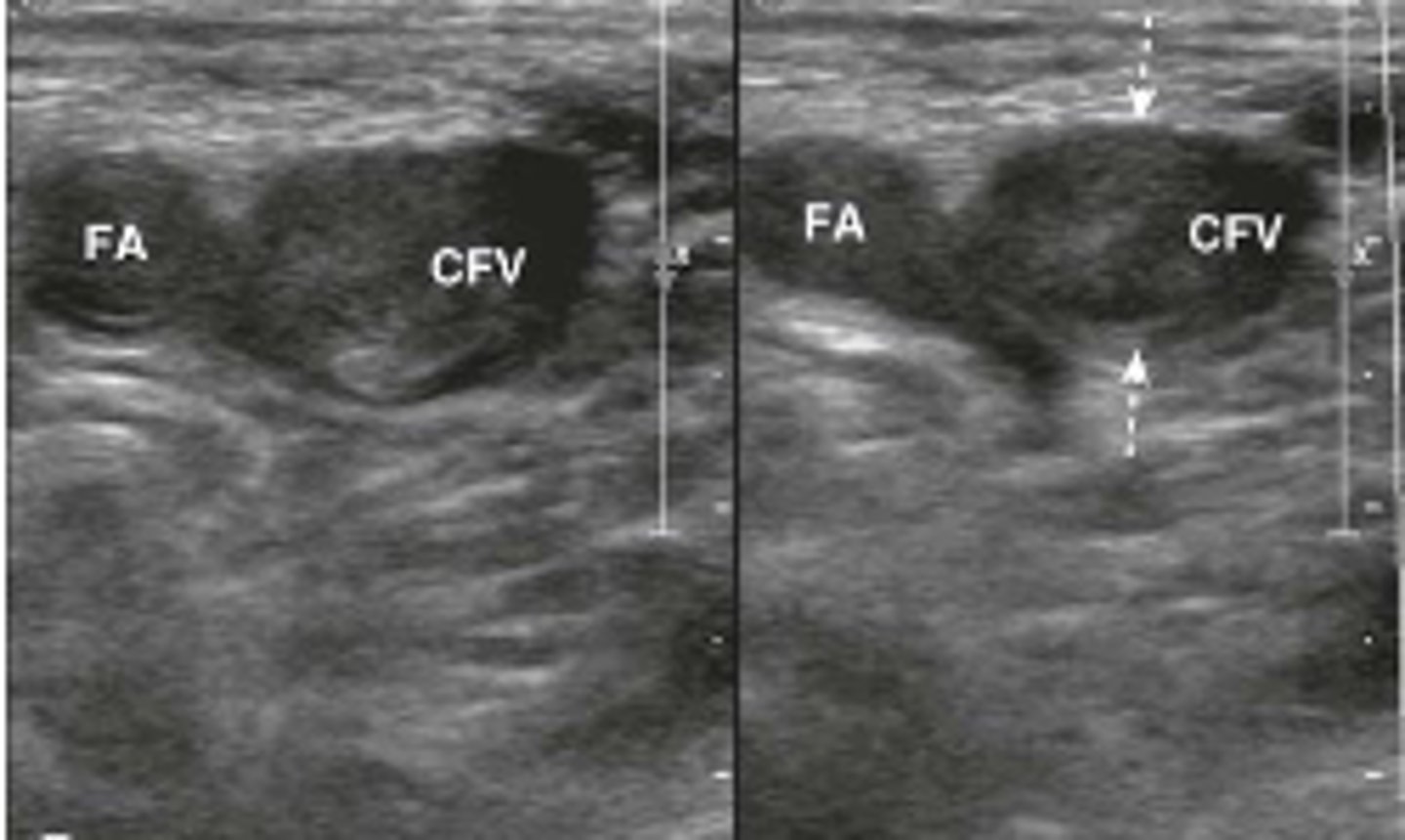 <p>On this ultrasound, you are applying pressure to compress this vein. What is the diagnosis?</p>