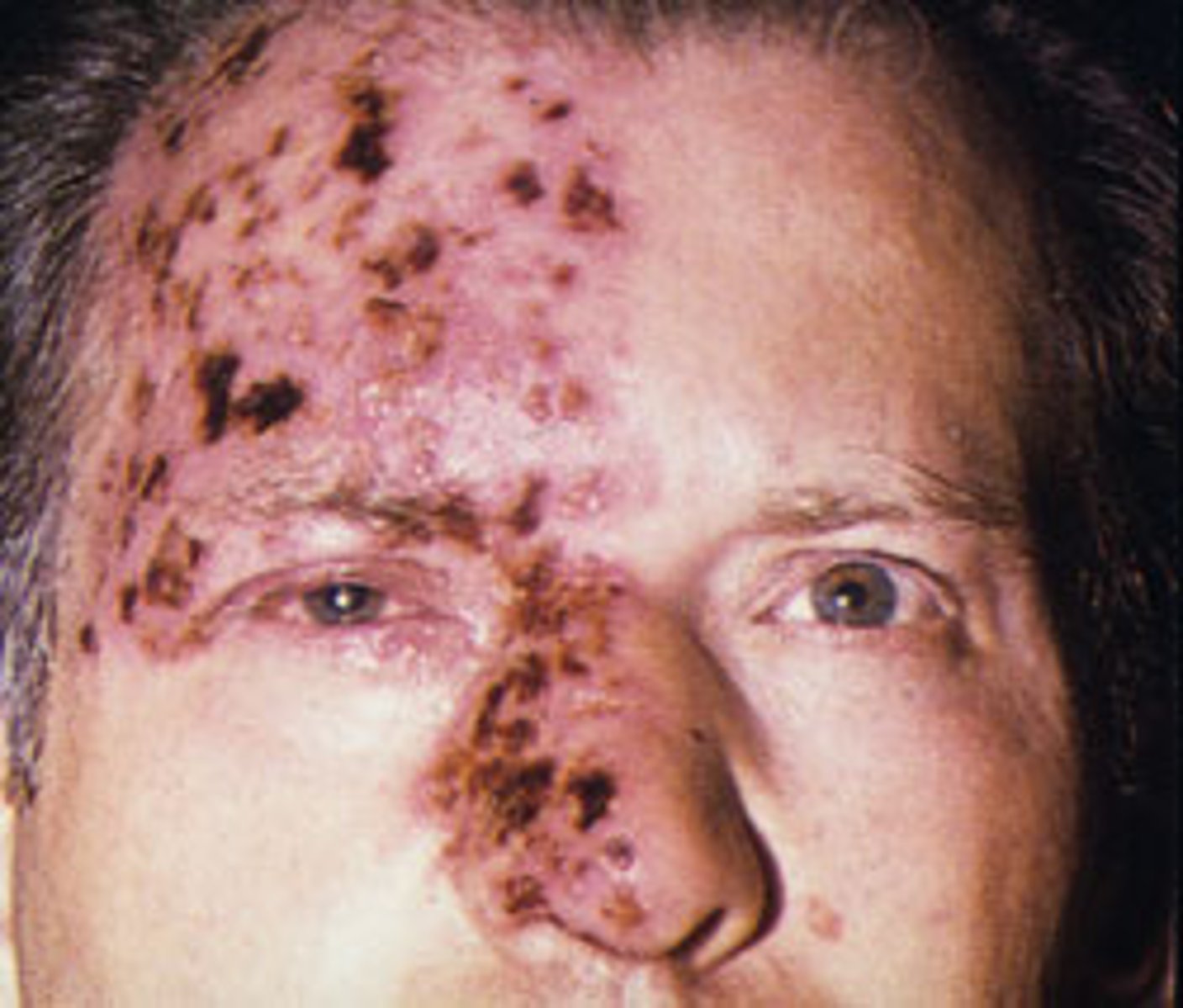 <p>Herpes Zoster Ophthalmalicus</p>