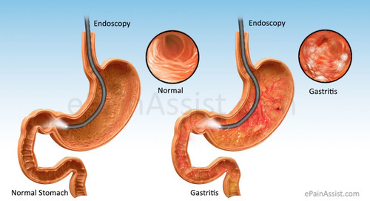 <p>EPI</p><p>- Inflammation of gastric mucosa caused by chronic stress to stomach lining</p><p>- Chronic ingestion of irritating foods</p><p>- Pathogens like H.Pylori, E.coli, and salmonella</p><p>- Overuse of aspirin or NSAIDs</p><p>- Stress</p><p>PATHO</p><p>- Prolonged irritation of the stomach (NSAIDS, alcohol, H-pylori, pernicious anemia)</p><p>- Helicobacter pylori-gram negative bacterial may also come from contaminated food that has not been washed well or cooked properly and contaminated water</p><p>- Acute (quick onset) and chronic (prolonged)</p><p>C/M</p><p>- Can be asymptomatic</p><p>- Epigastric pain</p><p>- N/V</p><p>- Decreased appetite</p><p>- Change in color of stool</p><p>- Pain can be exacerbated with the ingestion of spicy foods</p><p>- Acute or exacerbations of chronic gastritis, there may be evidence of dehydration or upper GI bleeding. With significant fluid or blood loss, the patient may develop signs of hypovolemic shock</p><p>DX</p><p>- Biopsy</p><p>- Upper GI x-ray series or endoscopy and histological exams of tissue specimen from biopsy</p><p>- Stool testing for presence of occult (blood) in stool</p><p>- Urea breath testing to detect active infection with H.Pylori</p><p>SURGERY</p><p>- very rare</p><p>- vagotomy</p><p>- partial or total gastrectomy</p><p>- pyloroplasty</p><p>MEDS</p><p>- supportive care for relieving clinical manifestations</p><p>- IV fluids and clear liquids</p><p>- Reducing cause of discomfort</p><p>- Medications for H.Pylori (antacids, PPIs, Antibiotics, aka triple therapy)</p><p>- Sucralfate (Carafate)</p><p>- GI rest</p><p>ASSESSMENT/ANALYSIS</p><p>- epigastric pain</p><p>- N/V</p><p>- decreased appetite</p><p>- weight loss</p><p>- change in color of stool</p><p>ASSESSMENT</p><p>- vitals</p><p>- hx of presenting s/s</p><p>- lab assessments for H.Pylori</p><p>- serum electrolytes</p><p>- I/Os</p><p>TEACHING</p><p>- immediately report hematemesis</p><p>- take medications are prescribed</p><p>- avoid irritants associated with gastric episodes</p><p>- NPO (6 to 12 hrs) then introduce clear liquids slowly then progress diet</p><p>- Antiemetics</p>