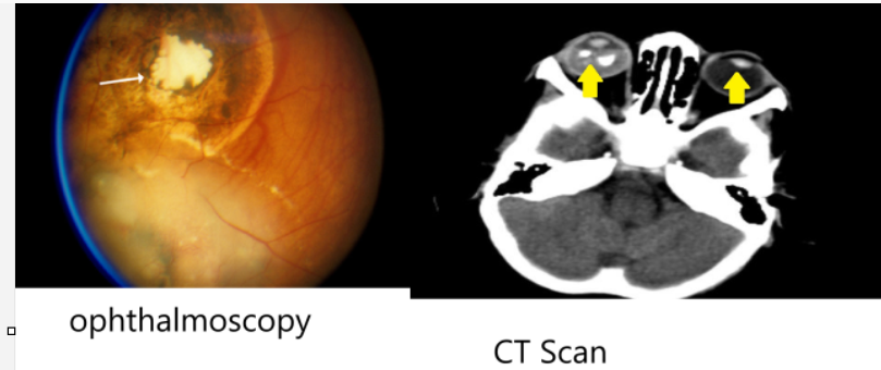 <ol><li><p>ophthalmoscopy </p></li><li><p>CT scan</p></li></ol><p></p>
