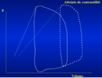 <ul><li><p class=""><strong>Augmentation du volume de remplissage</strong>&nbsp;(le cœur se dilate)</p></li><li><p class=""><strong>Diminution du volume éjecté</strong>&nbsp;(le cœur expulse moins de sang)</p></li><li><p class=""><strong>Diminution de la contractilité</strong>, traduite par une&nbsp;<strong>baisse de l’élastance télésystolique</strong></p></li><li><p class=""><strong>Augmentation de la pression diastolique</strong>, ce qui reflète une&nbsp;<strong>augmentation de l’élastance télédiastolique</strong></p></li><li><p class=""><strong>Travail interne fortement accru</strong>&nbsp;:<br>→ Délimité par :</p><ul><li><p class="">L’élastance télédiastolique</p></li><li><p class="">L’élastance télésystolique</p></li><li><p class="">La contraction<br>→ Conséquence :&nbsp;<strong>augmentation de la consommation en O₂</strong></p></li></ul></li></ul><p></p>