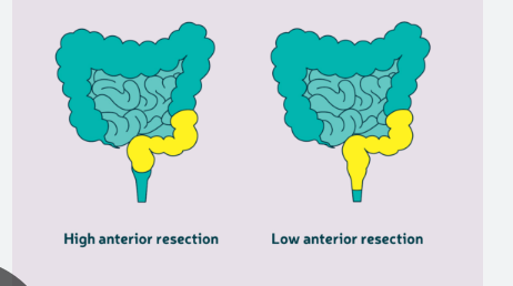 <ul><li><p>en bloc tumor removal + lymph node dissection </p></li><li><p>Bowel is reanastomosed (reattached)- so colostomy is not required  </p></li></ul><p></p>
