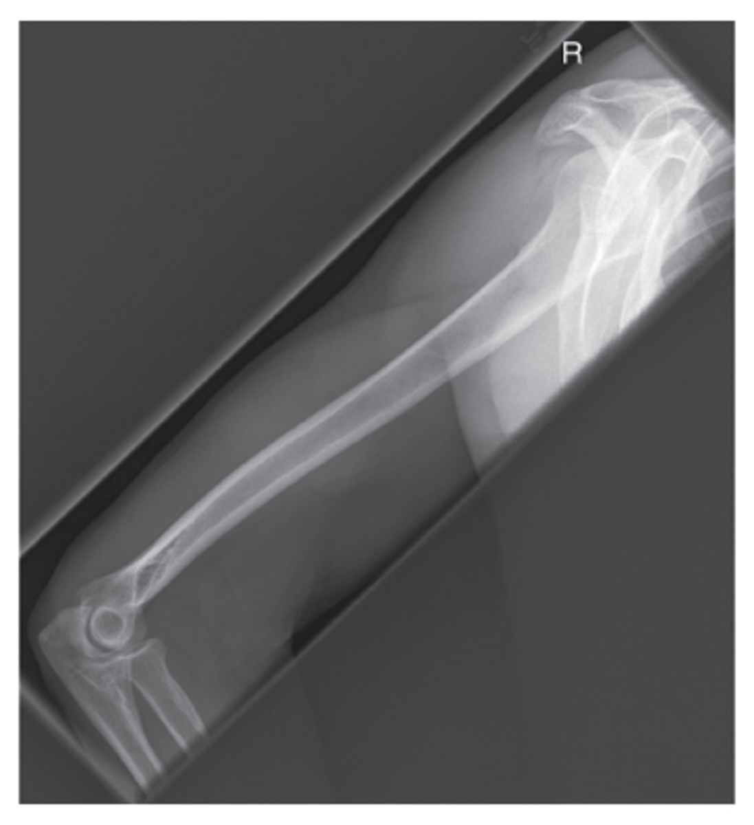 <p>- Epicondyles perpendicular to IR</p><p>- CR to midhumerus</p><p>- Entire humerus demonstrated</p><p>- Lesser tubercle in profile</p><p>- Epicondyles superimposed</p><p>- Exposure factors</p>