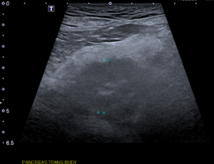 <p>-better for identifying acute pancreatitis (poor for chronic)</p><p>-difficult to differentiate chronic pancreatitis from pancreatic nodular hyperplasia (incidental finding in older pets)</p><p>-may not be able to see LEFT limb of pancreas - <span>difficult to visualize due to gas artifact (acoustic shadowing) from the stomach and/or colon </span></p>