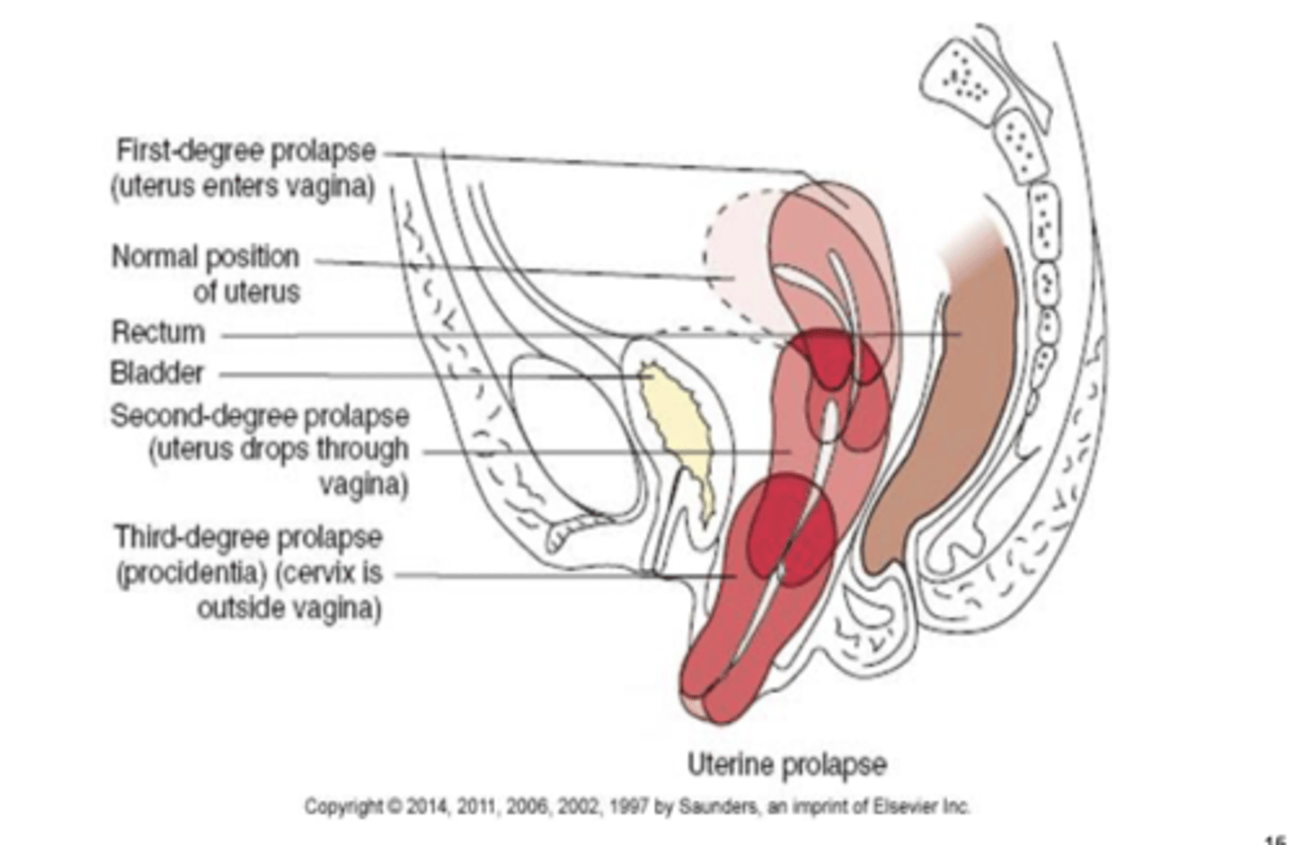<p>first-degree prolapse: cervix drops into the vagina</p><p>second-degree prolapse: cervix lies at opening of vagina and body of uterus is in vagina</p><p>third degree prolapse: uterus and cervix protrude through vaginal orifice </p>