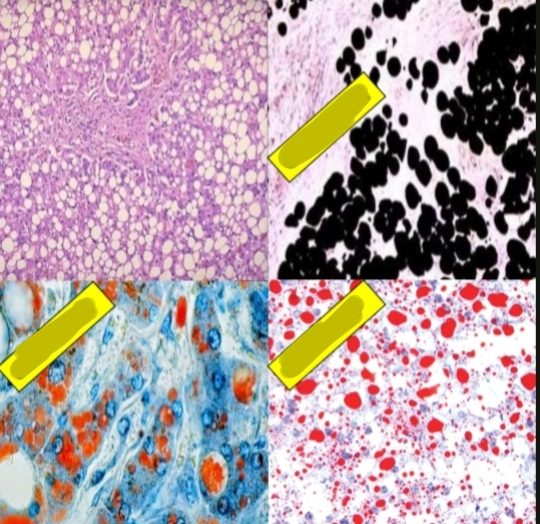 <p>What condition is shown and how does it appear with H&amp;E stain and other special stains”mention thier names”?</p>