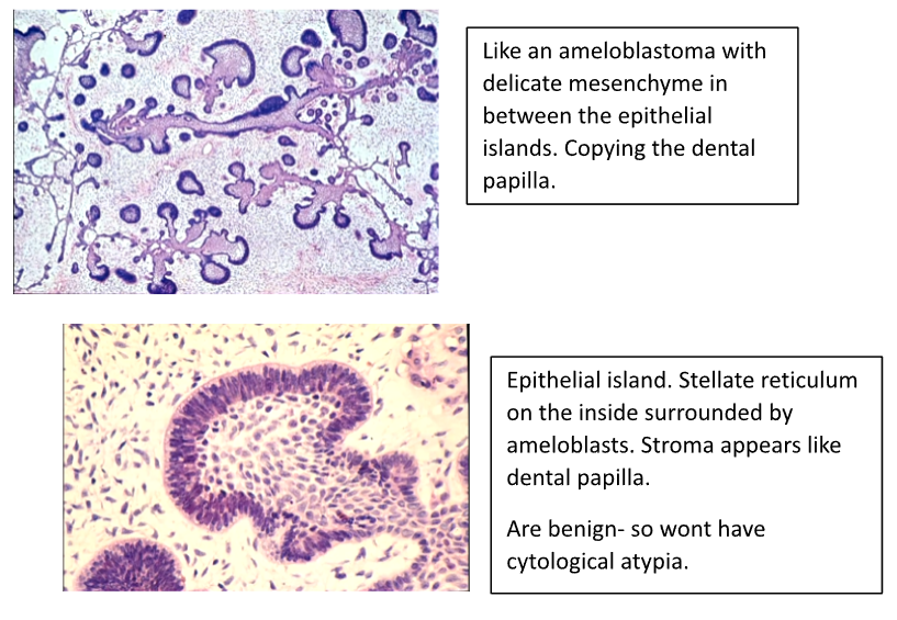 <p>- Branching Cords and Islands of Epithelium resembling Enamel Organ or Dental Lamina</p><p>- Characteristic Fine Cellular Stroma</p>