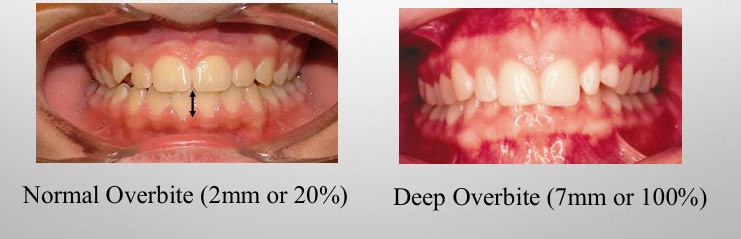 <p>-the amount of overlap of the mandibular anterior teeth by the maxillary anterior teeth measured perpendicular to the occlusal plane</p><p>-recorded in mm or percentage of lower incisor coverage (percentage preferred)</p><p>-coverage could be buccally</p>