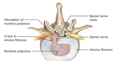 <p>Herniated disc</p>