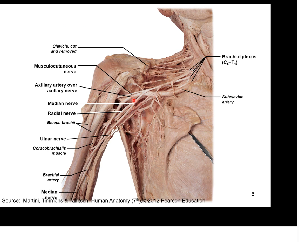 <p>median nerve- cuz running midline of the 3 nerve bundle</p><p>musculocutaneous- towards upper arm muscles</p><p>ulnar nerve- running down ulnar side so most medial of the 3 nerves in the anterior division and it is coming of the medical cord</p><p>in posterior division it branches off into the auxiliary nerve- right into the armpit and into shoulder</p><p>radial nerve- running down posterior side of the arm and the forearm</p>