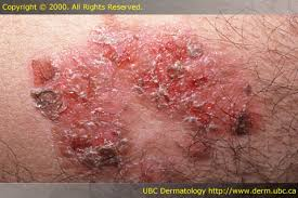 <p>(n)_[Count]: a hard outer layer formed on the skin after a wound or infection dries.</p>
