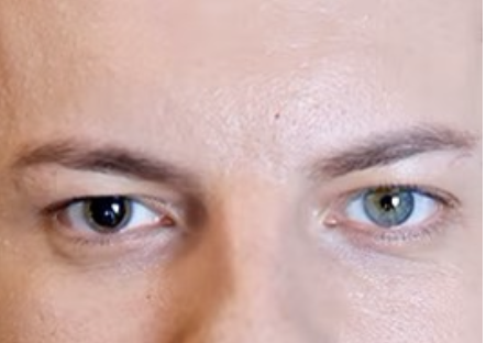 <p><span>How would you document this patient’s pupils?</span></p><p></p>