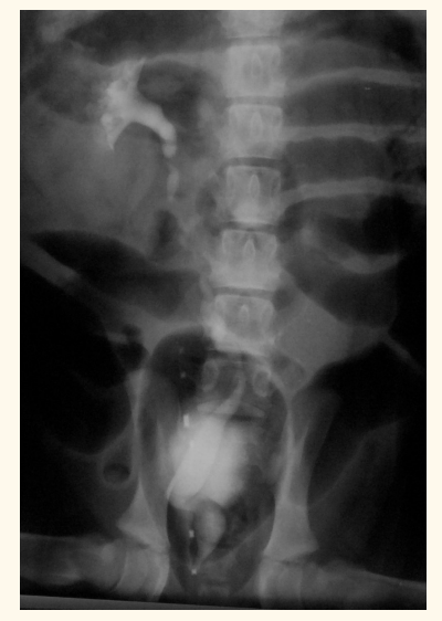 <p>ectopic ureter— hydroureter</p>