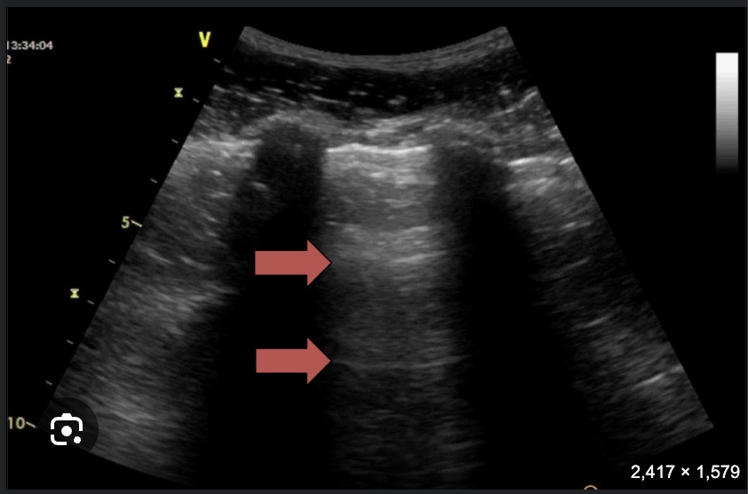 <p>What US finding are the arrows pointing to? Is this normal?</p>