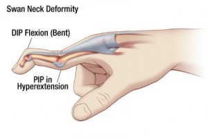<p>-Extension of PIP joint and flexion of MCP and DIP joints</p><p>-Result of contracture of intrinsic muscle or tearing of volar plate</p><p>-Common in RA</p>