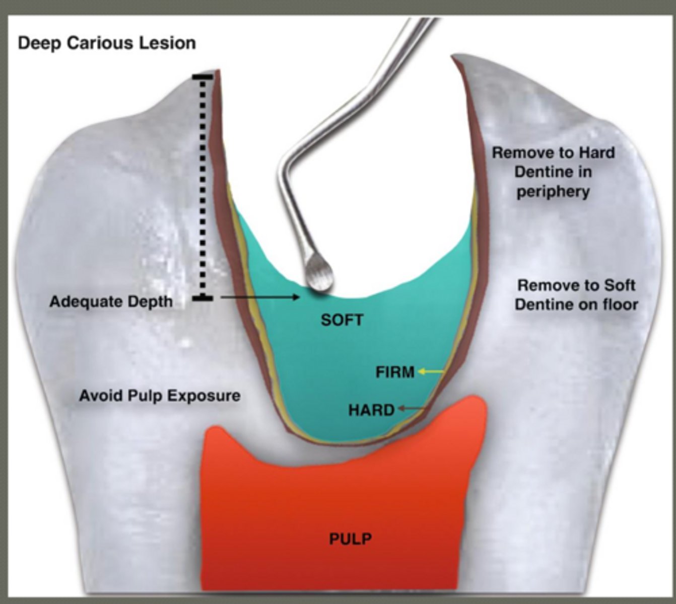 <p>- maintains vitality of pulp by preventing pulp exposure</p><p>- apply minimally invasive (MI) techniques</p><p>- decrease financial burden on pt.</p><p>- restore tooth health</p>