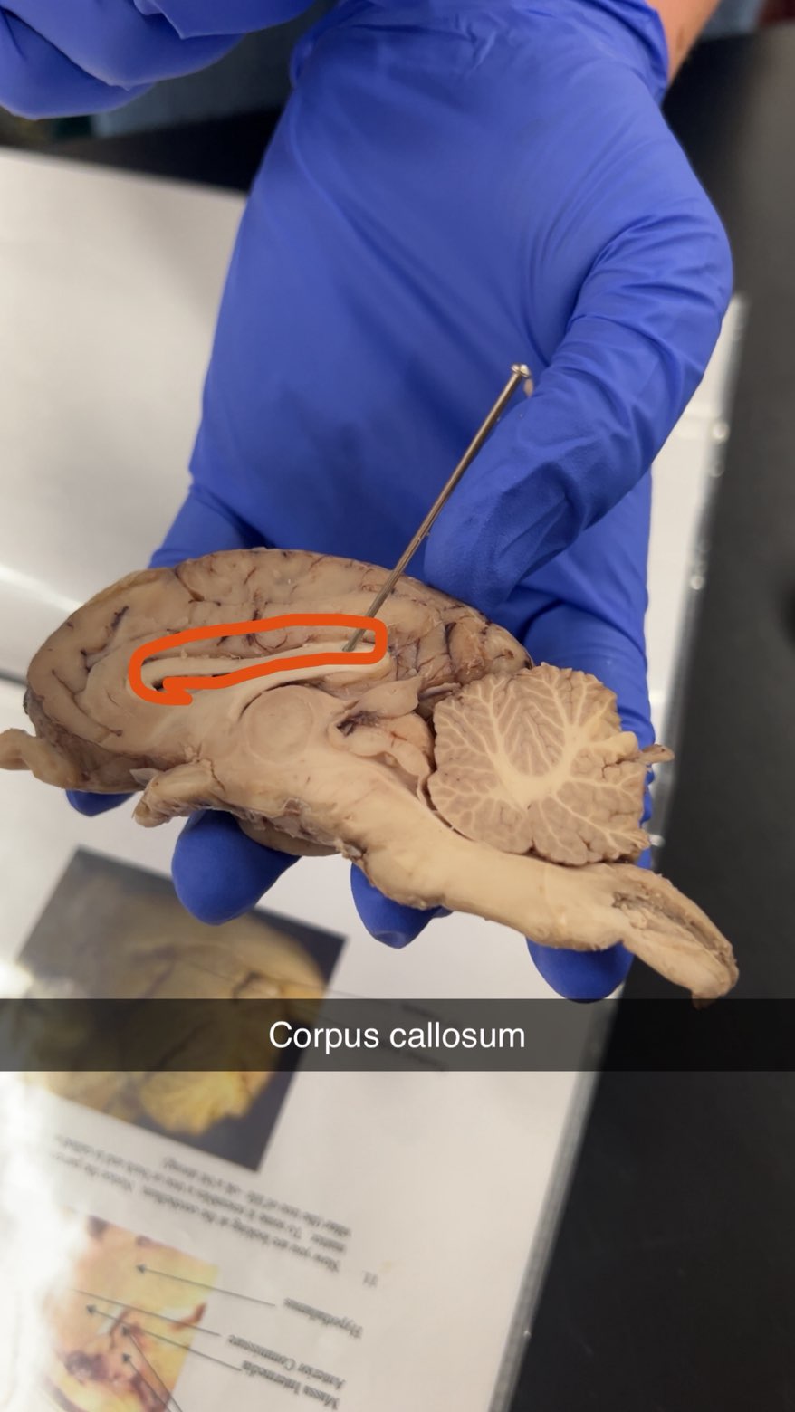 <p>corpus callosum</p>