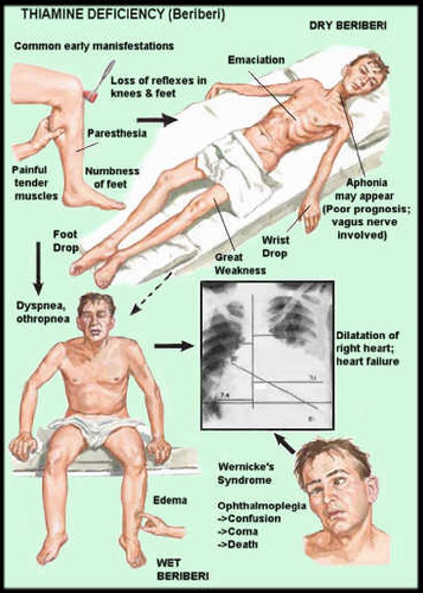 <p>1) Peripheral nerves numbness and paralysis - Dry beriberi</p><p>2) Enlarged heart / Peripheral edema - Wet beriberi</p><p>3) Brain of infants - Acute beriberi</p>