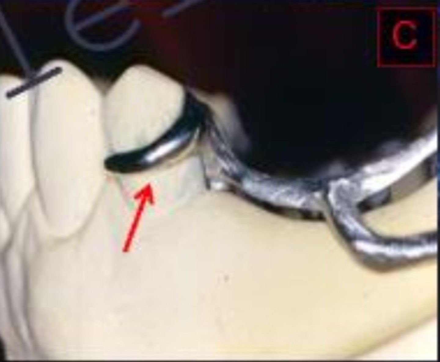 <p>When checking an RPD returned from the lab, the clasp should be what?</p>