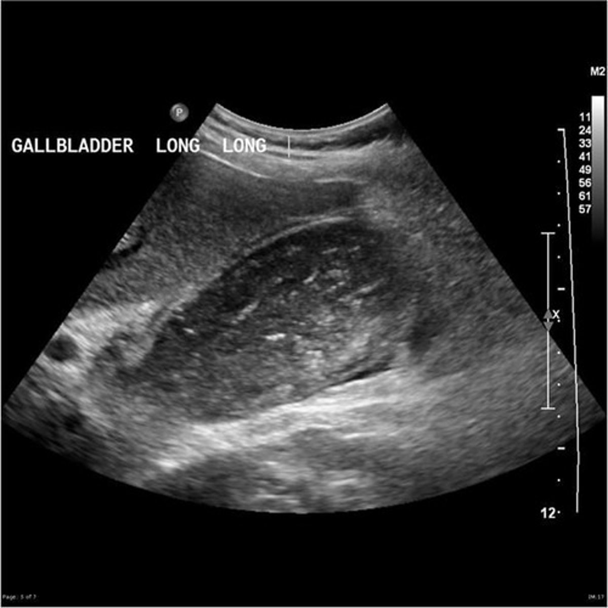 <p>-diffuse medium to coarse echogenic densities filling the GB lumen</p><p>-thickened GB wall</p><p>-focal wall necrosis, hemorrhage, or exudate (mass of cells and fludi thats seeped out of blood vessels or organ)</p><p>-bulges of GB wall</p><p>-ulcerations or perforations resulting in pericholecystic abscess</p><p>-gallstones or fine gravel</p><p>-distinct GB wall tear</p><p>-GB appear irregular in shape</p><p>-sludge</p>