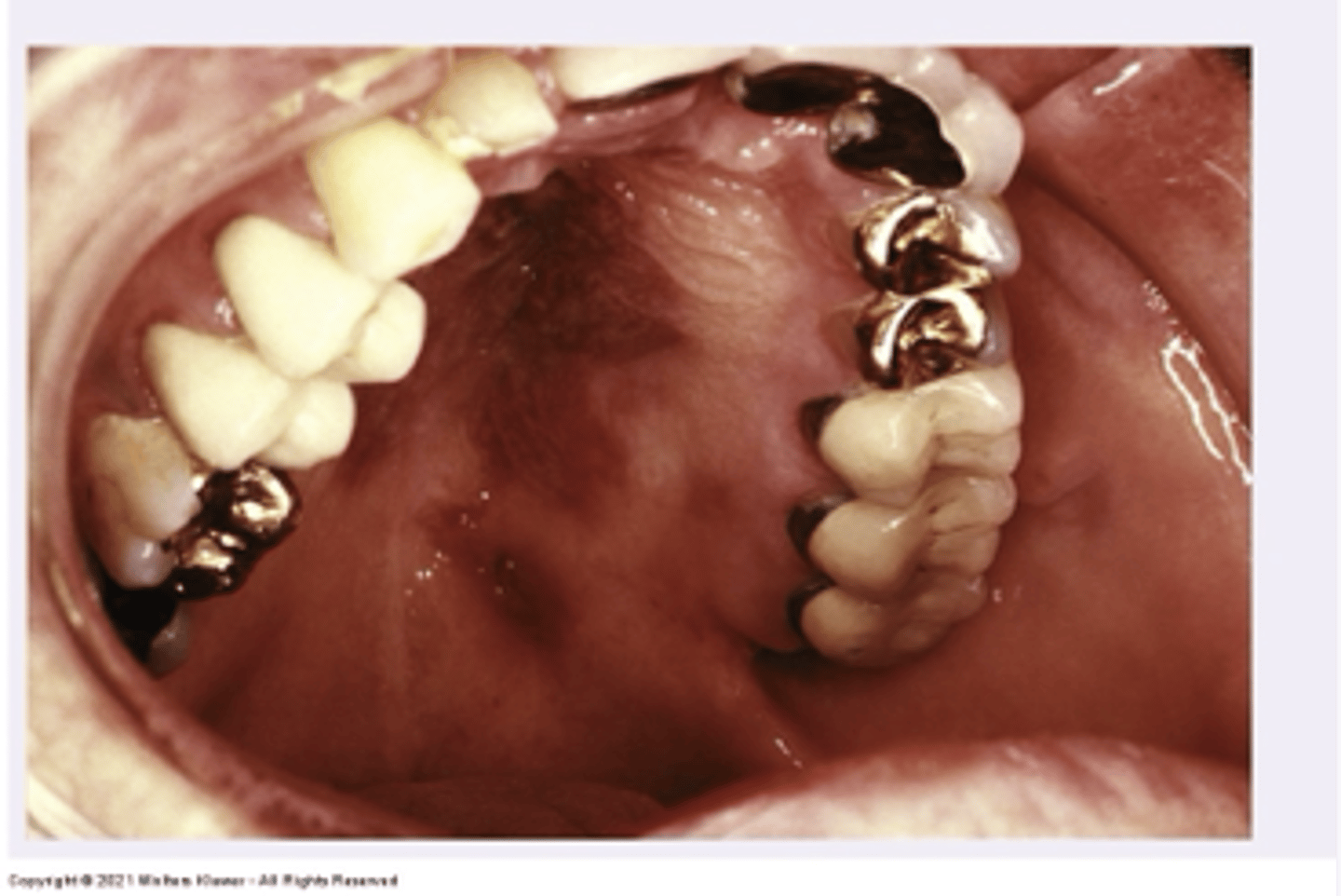 <p>This is a low grade vascular tumor associated with AIDS</p>