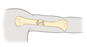 <p>Bone breaks into many fragments (particularly common in the aged, whose bones are more brittle). </p>