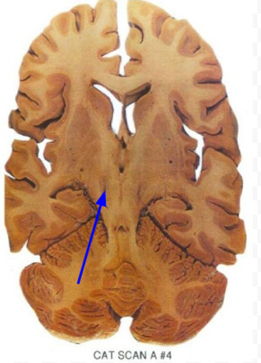 <p>An area of the midbrain that is involved in motor control and contains a large concentration of dopamine-producing neurons</p>