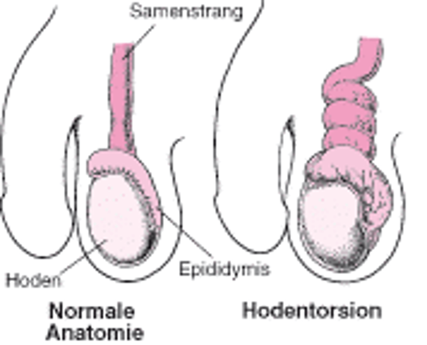 <p>die Hodenverdrehung</p>