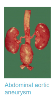 <p>Aneurysms</p>