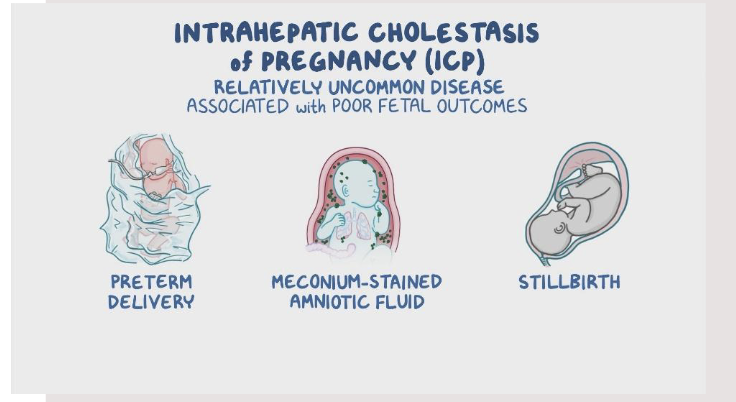 <p>Because <strong>bile acids build up in the mother’s blood</strong>, they can cross the placenta and affect the baby.</p><p>IOL at 37 weeks close monitoring otherwise</p><p></p><p><strong>treatment</strong></p><ul><li><p>Ursodeoxycholic acid (ursodial)</p><ul><li><p>monitor lab trends (bile salts</p></li><li><p>antihistamine prn - diphenhydramine (benadryl)</p></li><li><p>itching management —&gt; cool baths, oatmeal, products, topical creams</p></li></ul></li></ul><p></p>