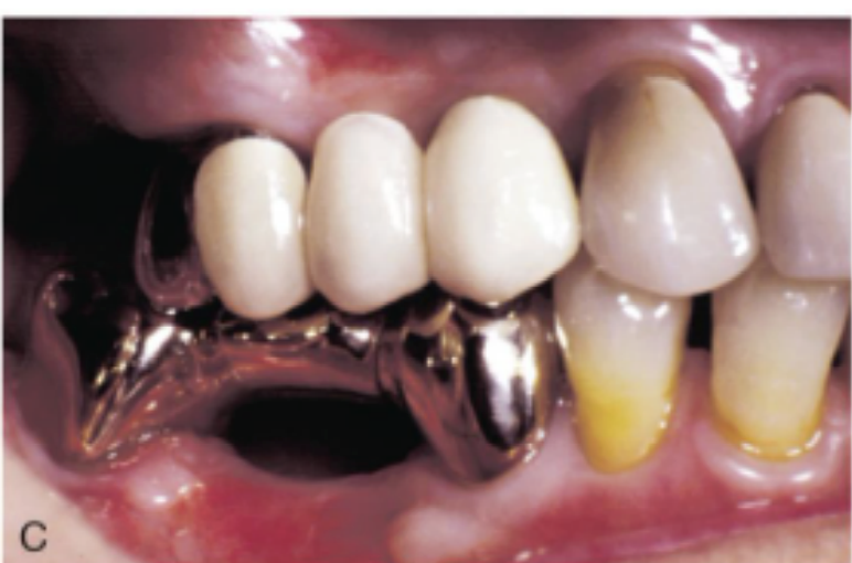 <ul><li><p>>/= 2 mm ridge-to-pontic space </p></li><li><p>pontic O-G thickness >/= 3 mm </p></li></ul><p></p>