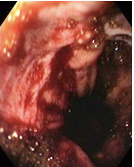 <p>Patient presents to the ER for N/V. Patient states that she was working out and started to “puke out all of her blood.” She states that the blood was bright red and that her back hurts. On a physical exam you note mid-epigastric tenderness. Vitals are stable. Endoscopy shows a mucosal tear. What is your treatment plan?</p>