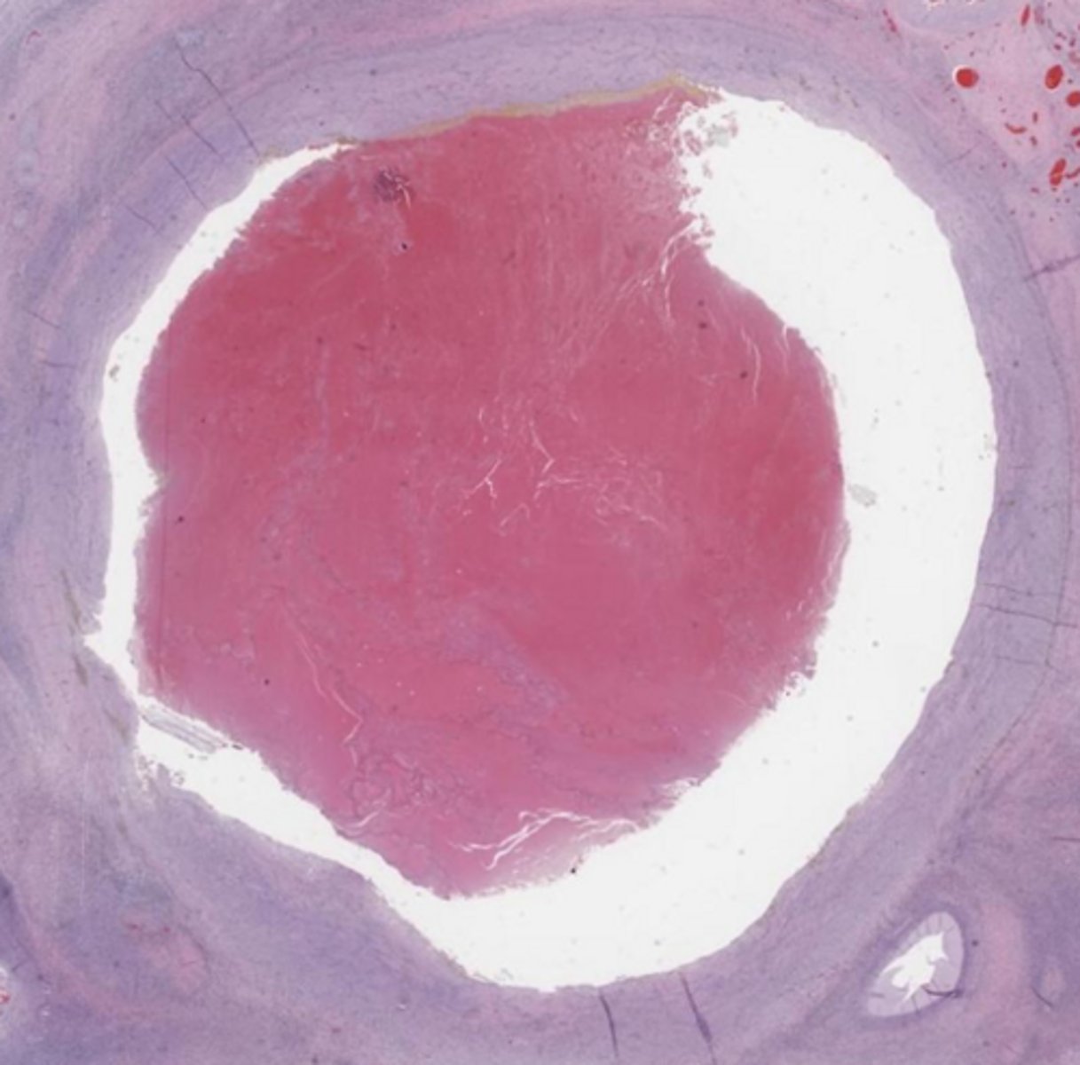 <p>ruptured follicle filled with hemorrhage</p>