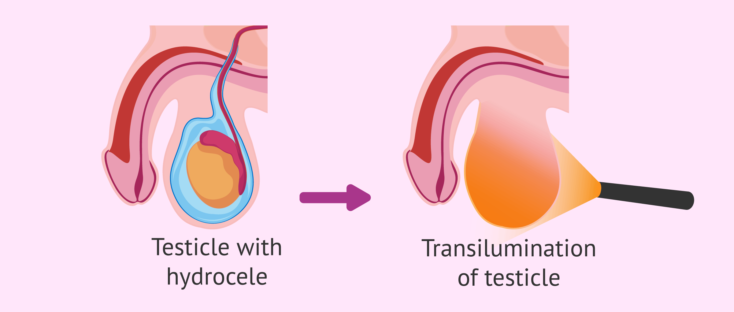 <p><strong>Scrotal Transillumination</strong></p><p>-Using a pen light, shine ______ from behind a scrotal ______ to observe whether the light travels through and ___________ the lesion</p><ul><li><p>Cystic (light shines through) → ____________ and large epididymal _____</p></li><li><p>_____ (light blocked by the mass) → mass readily transmits light </p></li></ul><p></p>