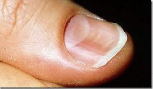 Iron deficiency anemia