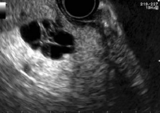 <p>Benign Serous Cystadenoma</p>