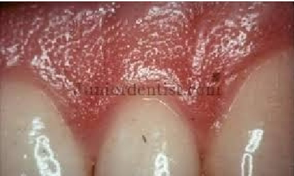 <p>Orange peel texture of attached gingiva</p>