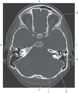 <p>Which line points to the occipital bone?</p>