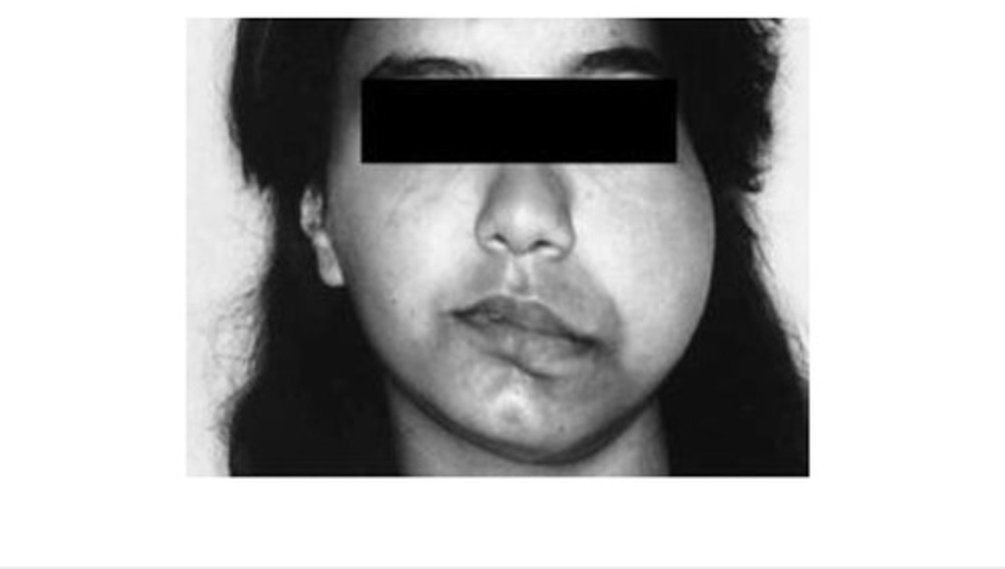 <p>This is a developmental enlargement of one side of the mandible including the condyle, condylar neck, ramus, and body, along with medial rotation.</p>