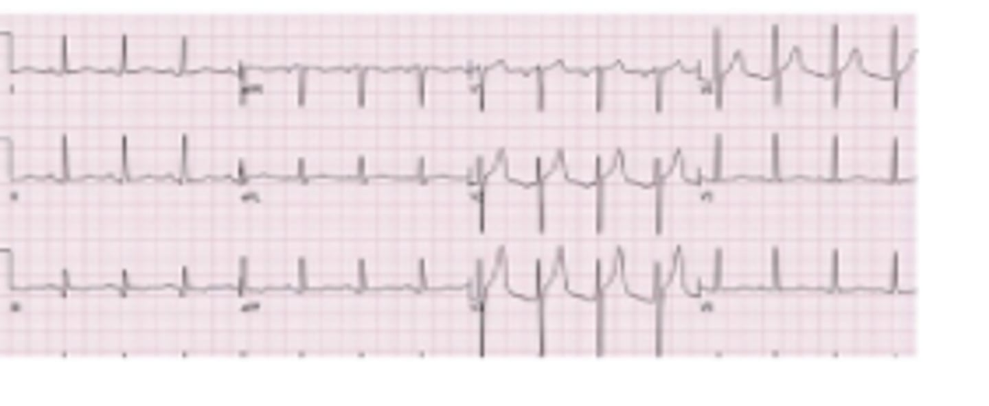 <p>A 62-year-old male with a past medical history of hypertension, hyperlipidemia, and type II diabetes mellitus presents to the emergency room with crushing substernal chest pain, shortness of breath, and diaphoresis. His symptoms began roughly 1 hour ago. ECG is as below. You are concerned for myocardial infarction and order a high sensitivity troponin. It is normal. Which of the following is true?</p><p>A.The patient is not having an MI and should be evaluated for other causes of chest pain</p><p>B.The patient is not having an MI and is safe for discharge home</p><p>C.The patient is having an MI and interventional cardiology should be consulted STAT</p><p>D.The patient may be having an MI; troponin levels should be repeated in 3 hours to check for elevations</p>