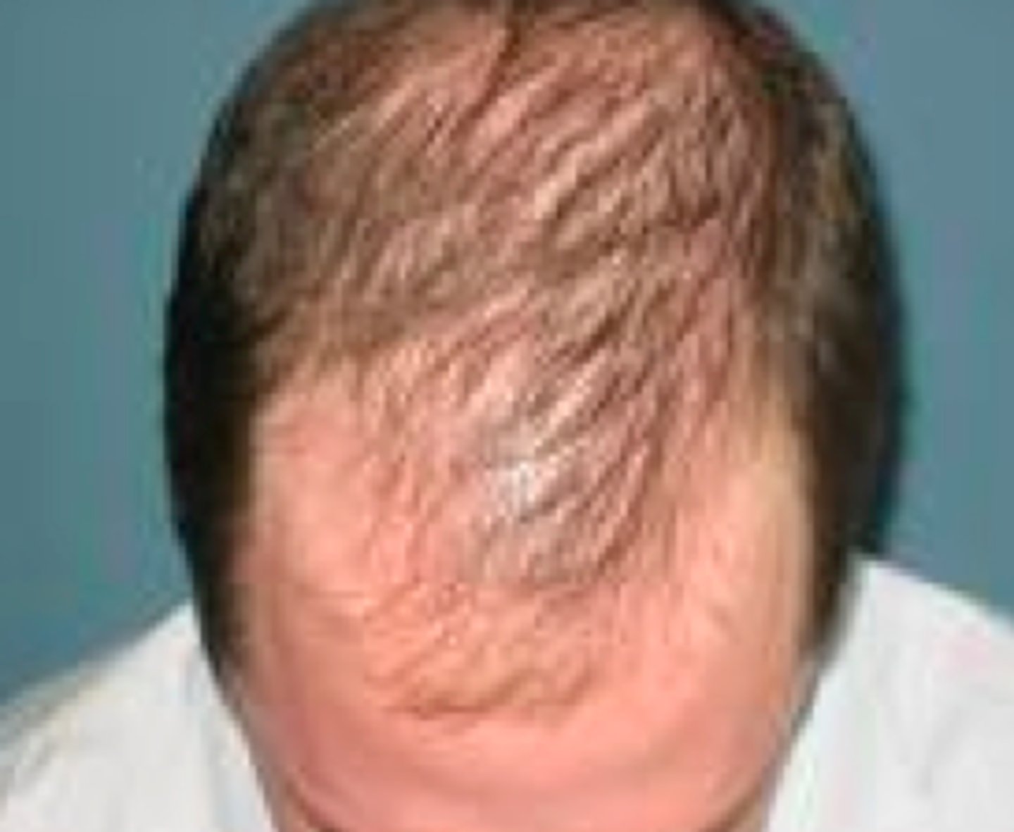 <p>Follicle shrinks over time</p>