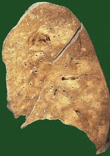 <p>Lung Abscess</p>