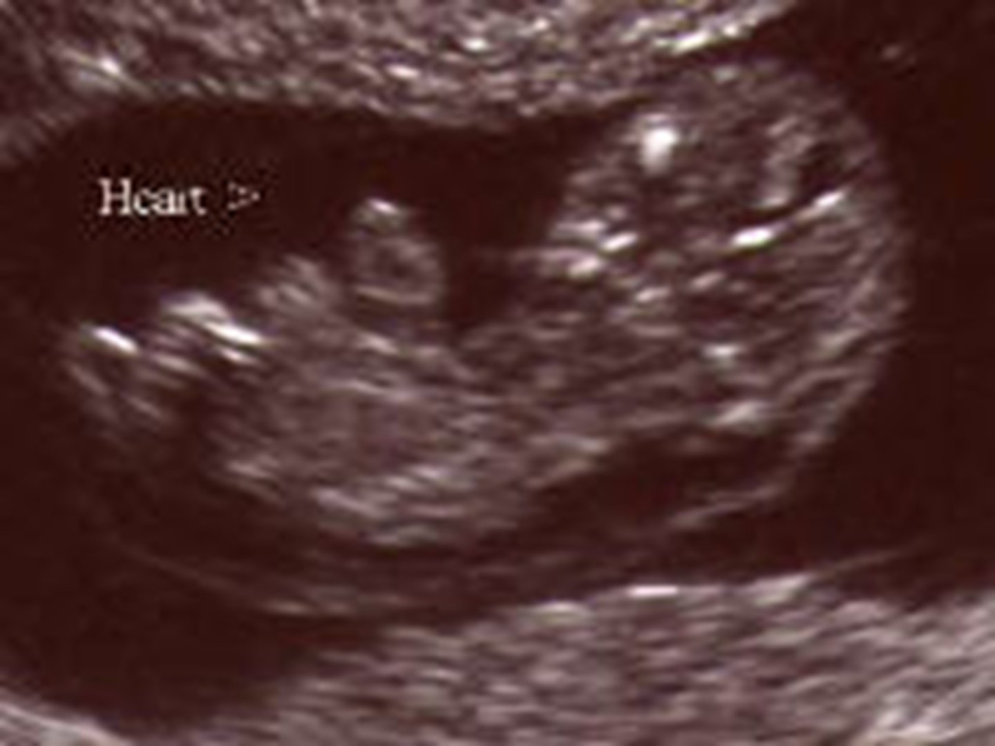 <p>midline defects characterized by omphalocele, ectopia cordis, diaphragmatic defect, pericardial defect, and sternal cleft.</p>