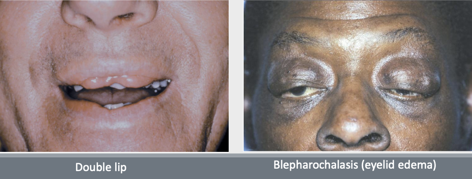 <p>Double lip (usually acquired), blepharochalasis (eyelid edema), nontoxic thyroid enlargement, congenital/sporadic (some are AD)</p>