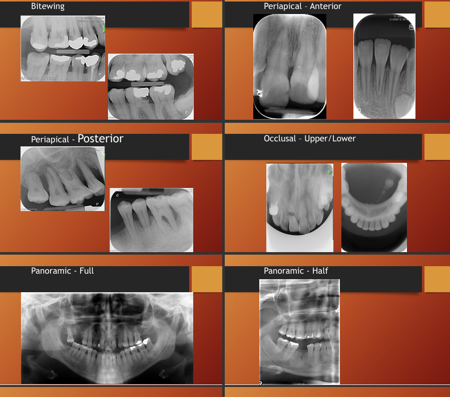 <p>Bitewing</p><p>periapical - anterior and posterior - allows you to see entire root</p><p>occlusal - upper and lower - may help see cracks in teeth</p><p>panoramic - full and half (sometimes if you are looking for a specific tooth you can do half, but if there is a problem that is not specific on one side it might be better to do a full so you can see if there is also anything wrong in the other side as well as its provides a good comparison)</p><p></p>