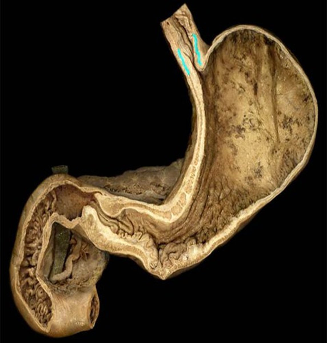 <p>Identify this specific ring of smooth muscle. This is also known as the gastroesophageal sphincter.</p>