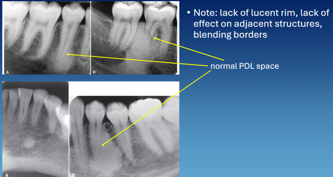 <ul><li><p>well defined </p></li><li><p>no RL rim, can blend w bone or lamina dura </p></li><li><p>PDL in tact </p></li><li><p>vital teeth but can induce resorption </p></li></ul><p></p>